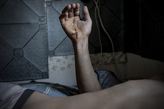 2021年09月23日   宁波  小诚在工作时意外受伤。