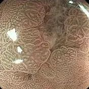 ▲精查胃镜下观察病灶