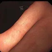 ▲复查时已完全愈合的手术创面