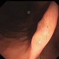 ▲普通胃镜下观察病灶