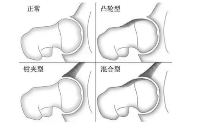 股骨髋臼撞击症及其分型示意图