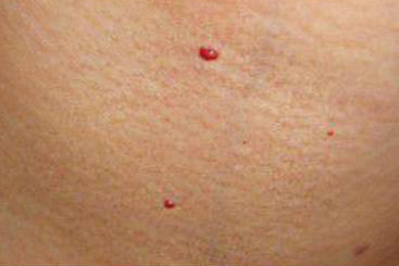 血管痣大多高出皮面,是由于皮肤表面毛细血管或小动脉增生和持续扩张