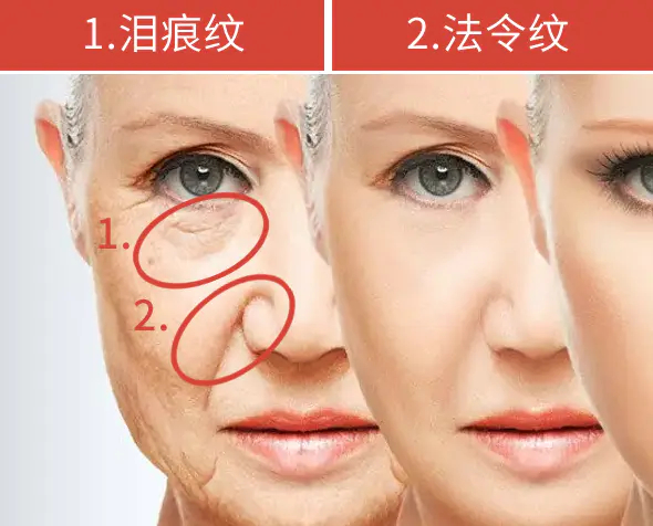 鼻子两侧八字纹很深怎么消除?如何淡化法令纹最有效?(6法)|皮肤|八字|鼻子