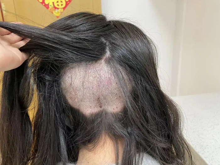 ▲大麦微针擅自剃掉周女士后脑勺的部分头发。周女士供图