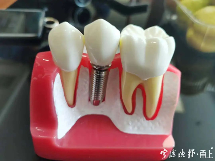 种植牙模型