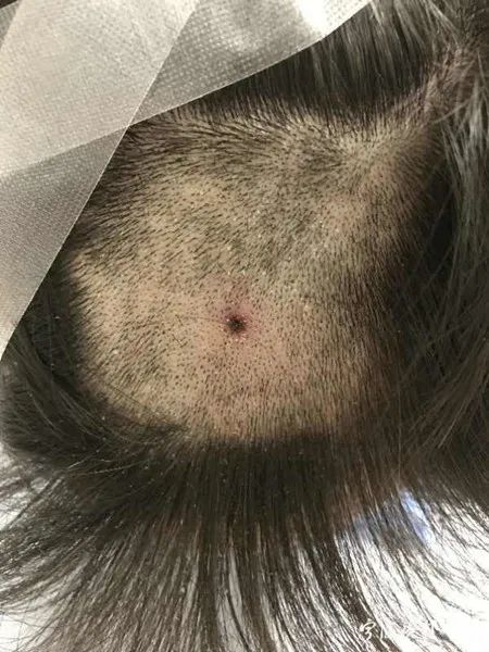 一位患者头部残留的蜱虫，图据宁波晚报