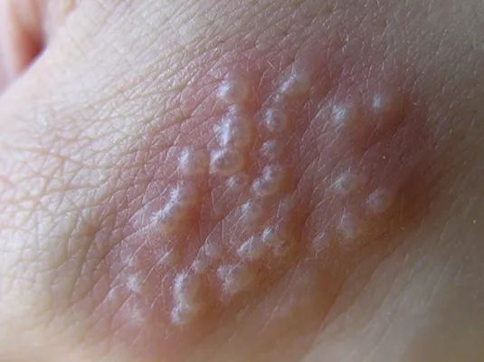 症状非常明显出现疱疹期间每年定期反复发作汗疱疹又称出汗不良性湿疹