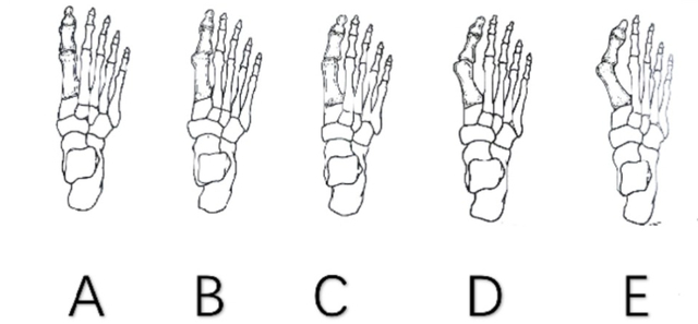 以低弓足或扁平足导致的第一跖列过度活动为例,我们在站立时前脚掌的