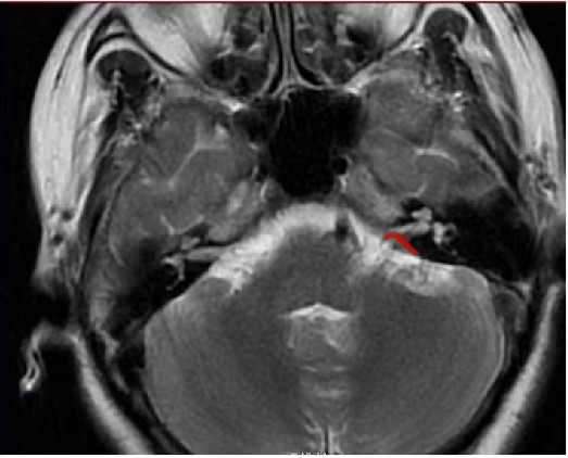 ▲影像学检查（图片中标红部位为责任血管位置）