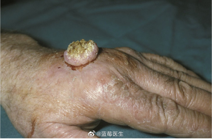角化棘皮瘤 一种常见的低级别(不太可能转移或侵入)快速生长的