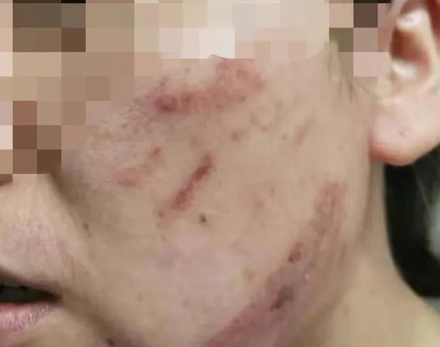 △王女士脸上的红印子 