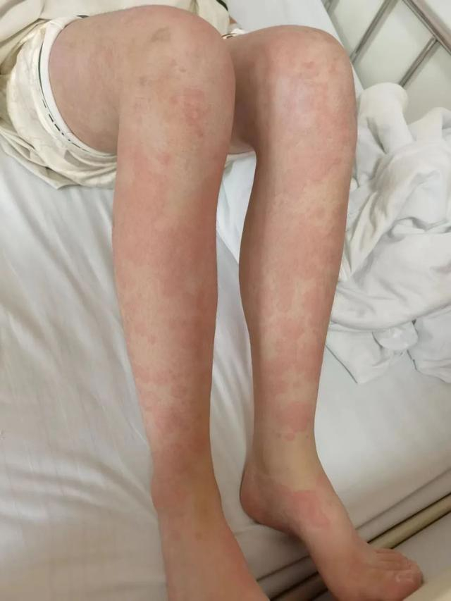 △小李（化名）腿上的皮疹