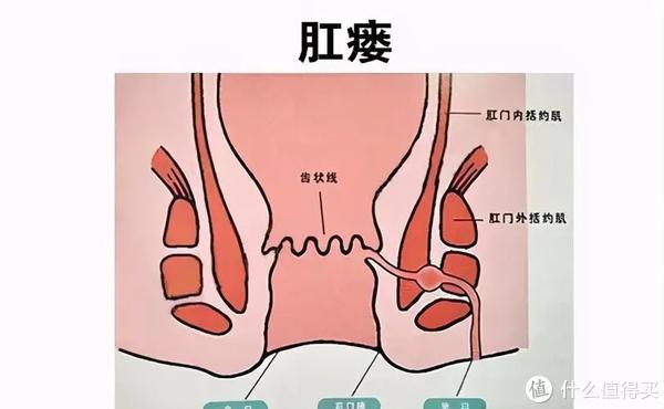 肛瘘和痔疮的区别（肛瘘和痔疮的区别在哪）