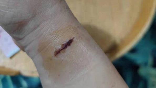 什么叫桡鞘“我,40岁,手术后再也提不起裤子”_新闻资讯_第10张_活检穿刺产品网 什么叫桡鞘“我,40岁,手术后再也提不起裤子”_https://www.jmylbn.com_新闻资讯_第10张