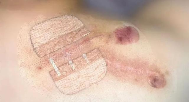 经过一段时间治疗后，奚梅背部的瘢痕疙瘩变软变平了不少（医生供图） 