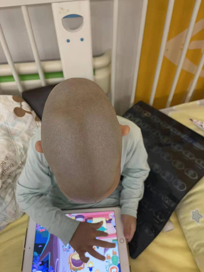 可可手术前，头型呈“舟状”