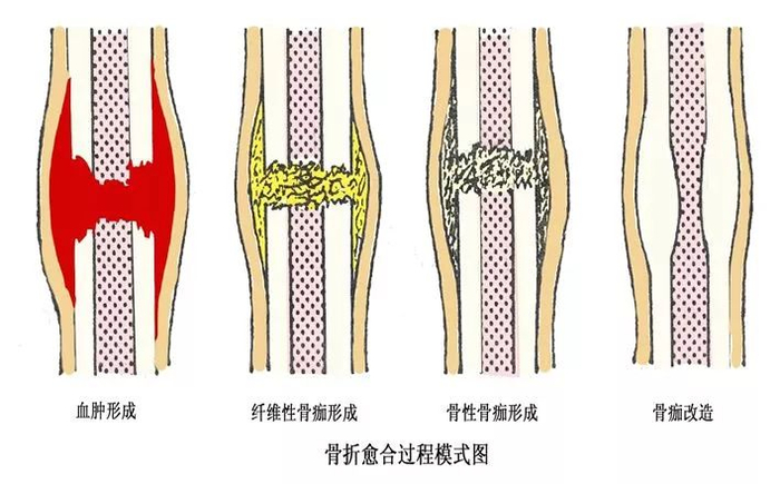 骨科直接牵引包括哪些骨科护理的那些基本知识，你都了解了么？_https://www.jmylbn.com_新闻资讯_第8张
