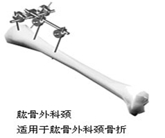 骨科直接牵引包括哪些骨科护理的那些基本知识,你都了解了么?_新闻资讯_第11张_活检穿刺产品网 骨科直接牵引包括哪些骨科护理的那些基本知识,你都了解了么?_https://www.jmylbn.com_新闻资讯_第11张