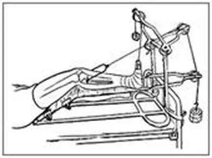 骨科直接牵引包括哪些骨科护理的那些基本知识，你都了解了么？_https://www.jmylbn.com_新闻资讯_第16张