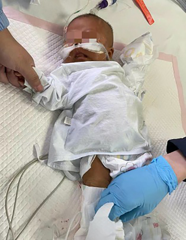 出生58天的患儿