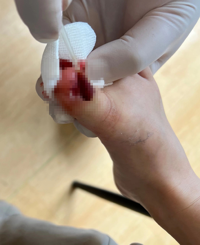 顾女士称孩子在斗柜周围玩耍时不慎被倒下的斗柜压伤右足大脚趾。