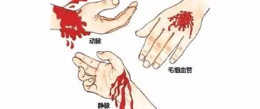 临床中各种出血的急救方法,学习收藏!|止血带|伤口|伤者|纱布|敷料_新浪新闻