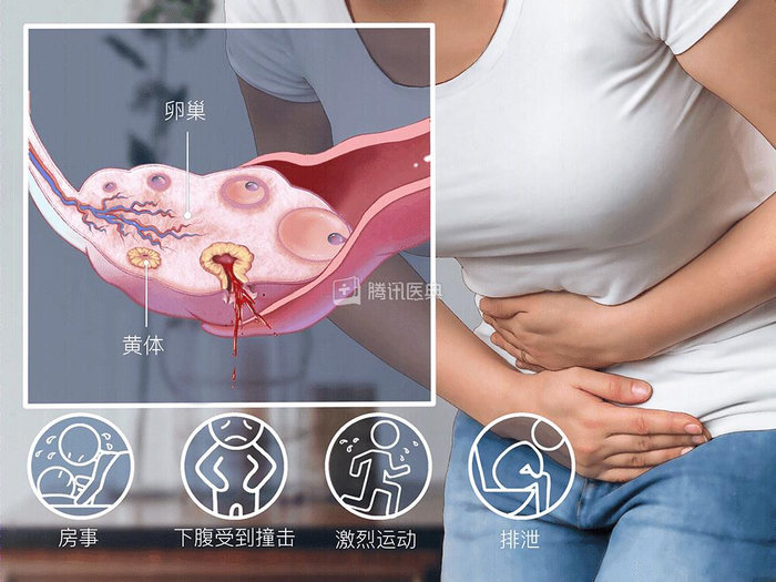 （黄体破裂示意图）
