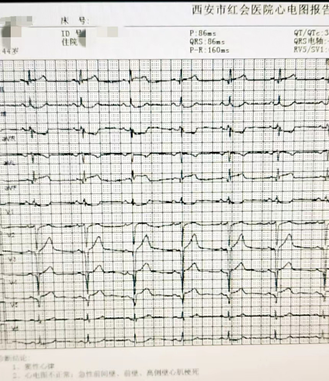 什么情况下使用除颤仪胸痛、胸闷持续4个小时?出现以下症状,或是心肌梗死来“报道”_新闻资讯_第4张_活检穿刺产品网 什么情况下使用除颤仪胸痛、胸闷持续4个小时?出现以下症状,或是心肌梗死来“报道”_https://www.jmylbn.com_新闻资讯_第4张