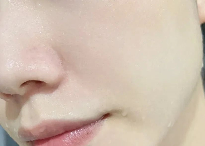 坚持用一段时间，脸真干净了