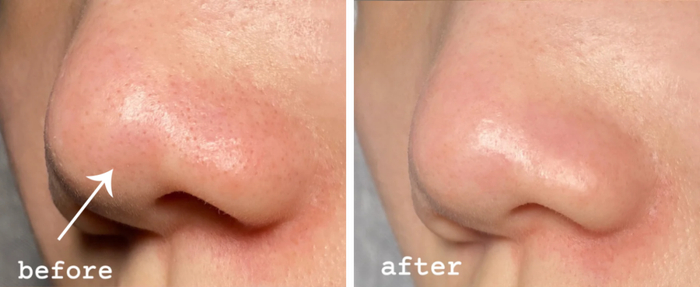 黑头不再狂长，爱死了