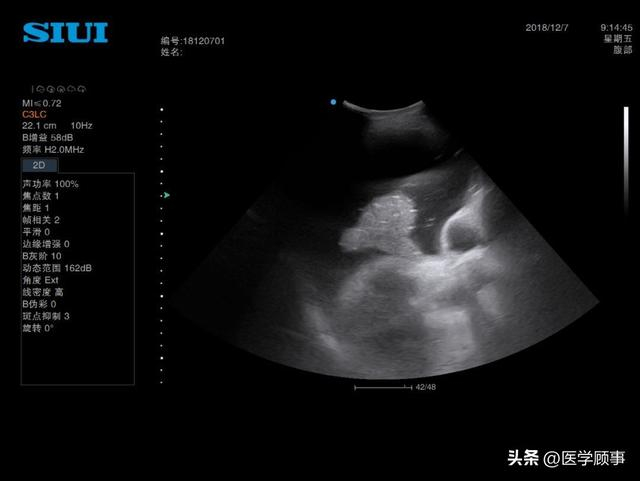 野战环境中的创伤超声重点评估(FAST)|CT_新浪新闻