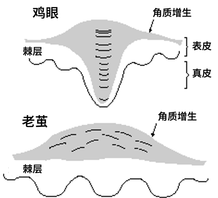 老茧和鸡眼的区别 图：参考文献（有改动）