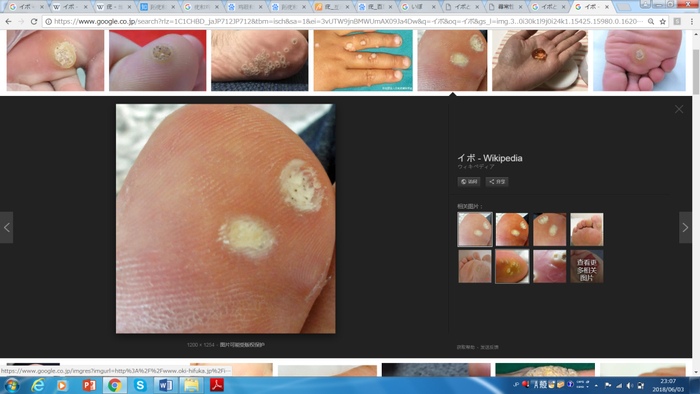 疣 图片来源：Wikimedia Commons