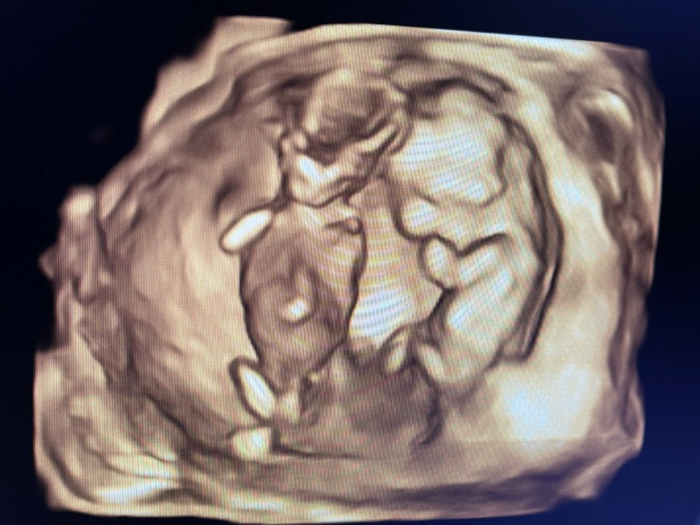 吴薇怀双胞胎时的B超图受访者供图