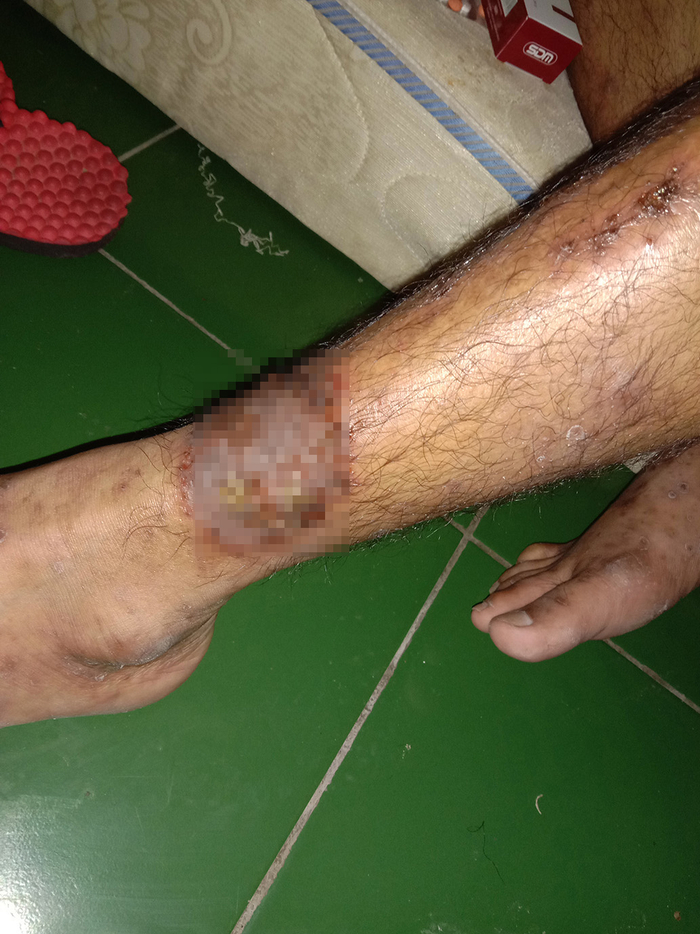 2021年，被遣返者患上了皮肤病。阿尔弗恩 供图