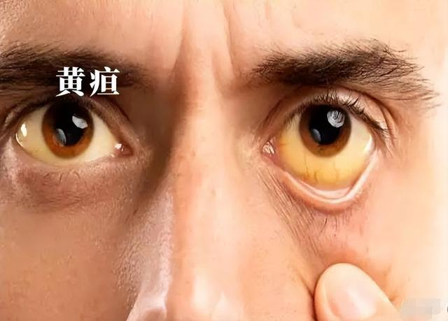 皮肤黄了,真的是因为患了肝病吗|肿瘤|肝病|黄疸_新浪新闻