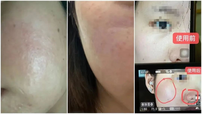 记者加入的“薇诺娜”冻干面膜维权群里，多位消费者发出使用后出现泛红的实拍照