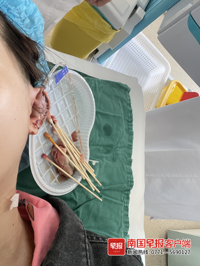 ▲陈女士的右耳软骨大面积坏死。受访者供图