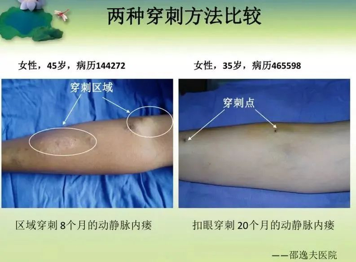 当护士这么多年,你知道“钝针”穿刺吗?