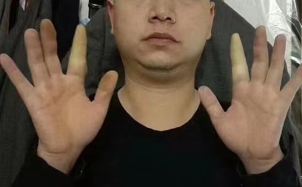 胡运良展示双手食指遇冷变白症状。&nbsp; 受访人供图