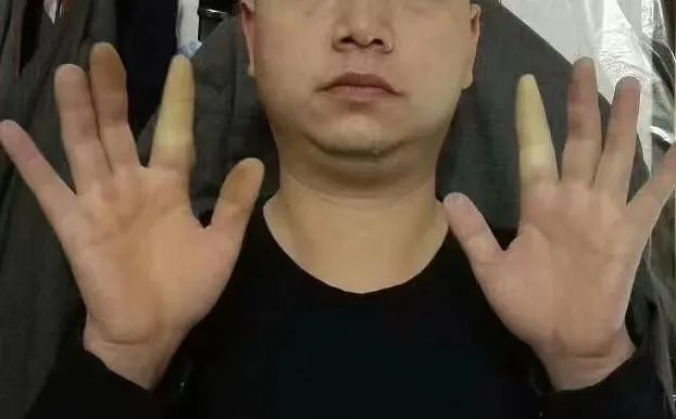 ▲胡运良展示双手食指遇冷变白症状。&nbsp; 受访人供图