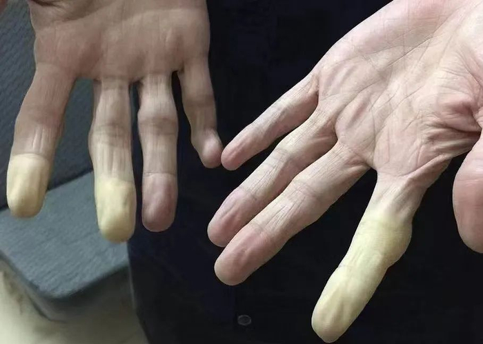 ▲患病工人罗来前展示患白指病症状。&nbsp; 受访人供图