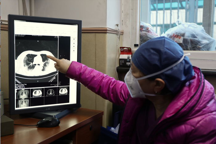 24日，北京中医医院重症医学科宋麦芬主任正在查看新冠患者肺部CT片。曹子豪摄