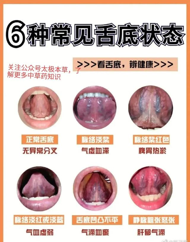 照镜子，看看舌下有青筋吗？