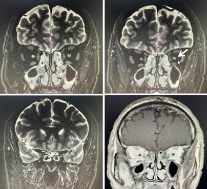 图1：患者视神经MRI