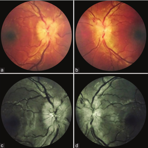 图 4 双眼视神经炎患者