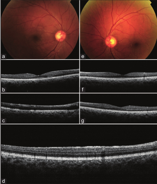 图 3 AMN合并PAMM（急性旁中心中层黄斑病变）