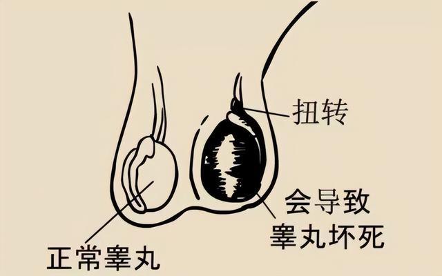 睪丸扭轉的患者通常會有陰囊疼痛,但新生兒除外.