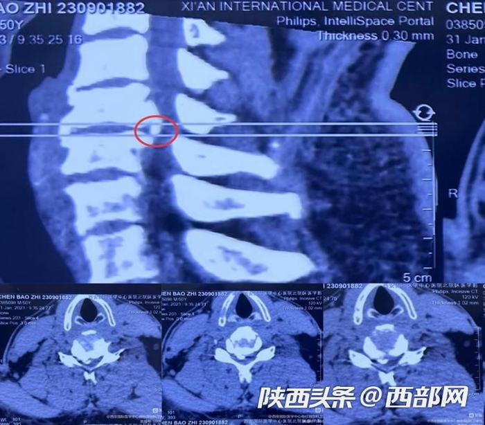 患者术前影像学资料