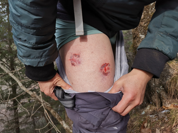 巡护员被野生大熊猫扑咬留下伤口。何夷栋提供